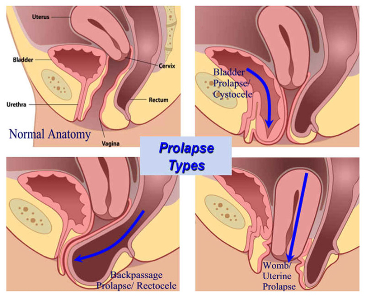 Schéma de l'utérus sortant par la vulve : descentes d'organes.