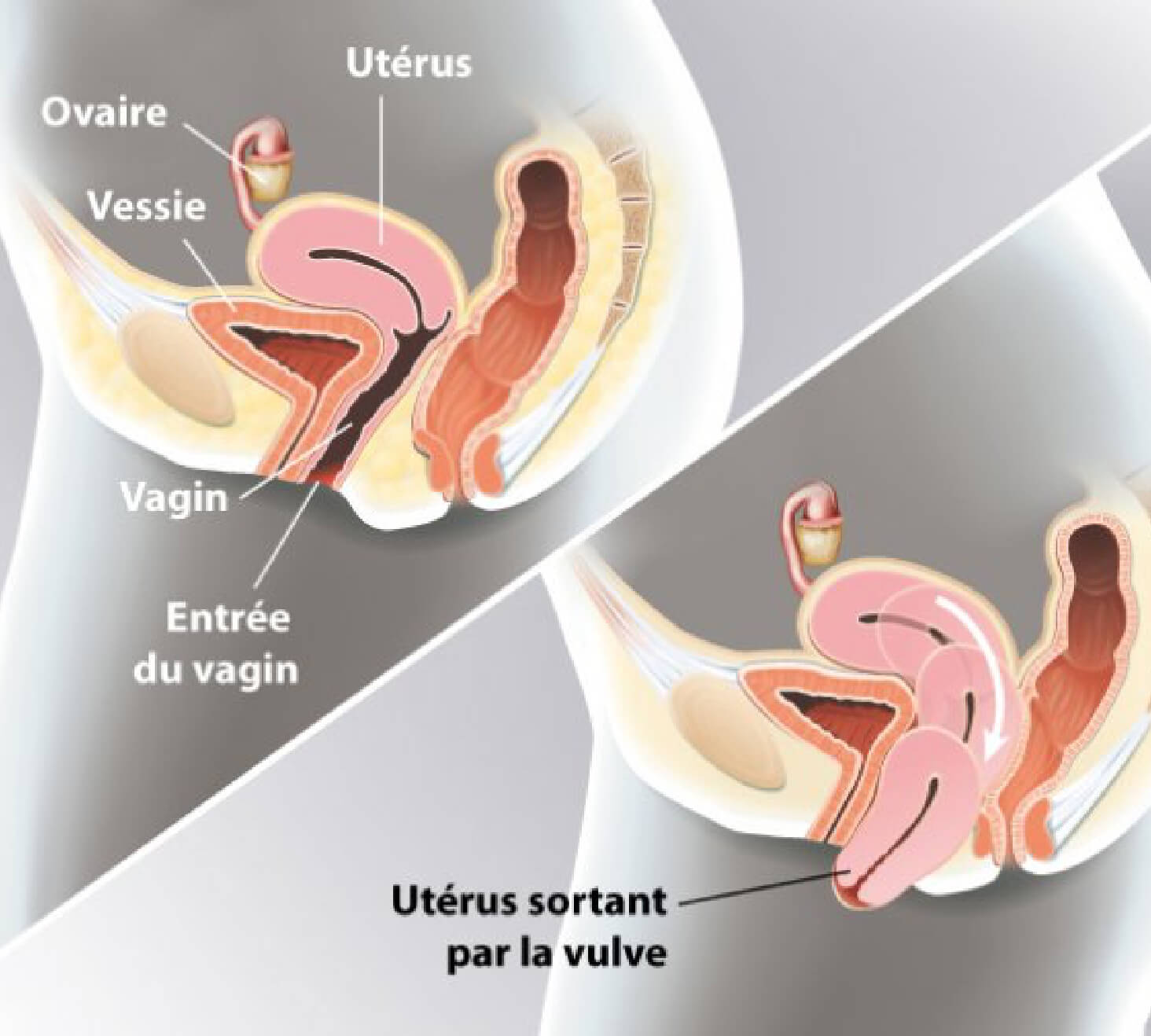 Descentes d'organes. Schéma de l'utérus sortant par la vulve : descentes d'organes.