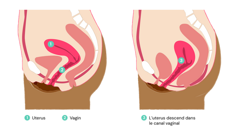 Schéma de l'utérus sortant par la vulve : descentes d'organes.